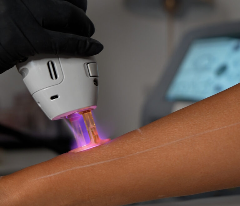 Laser Hair Removal in Dubai Silicon Oasis