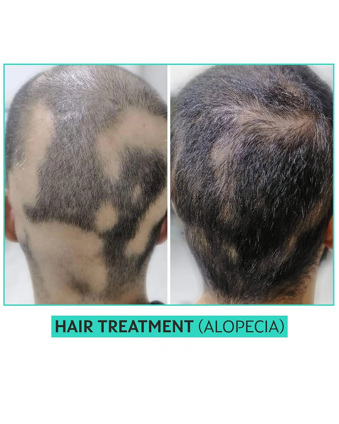 Best PRP Hair Treatment in Dubai