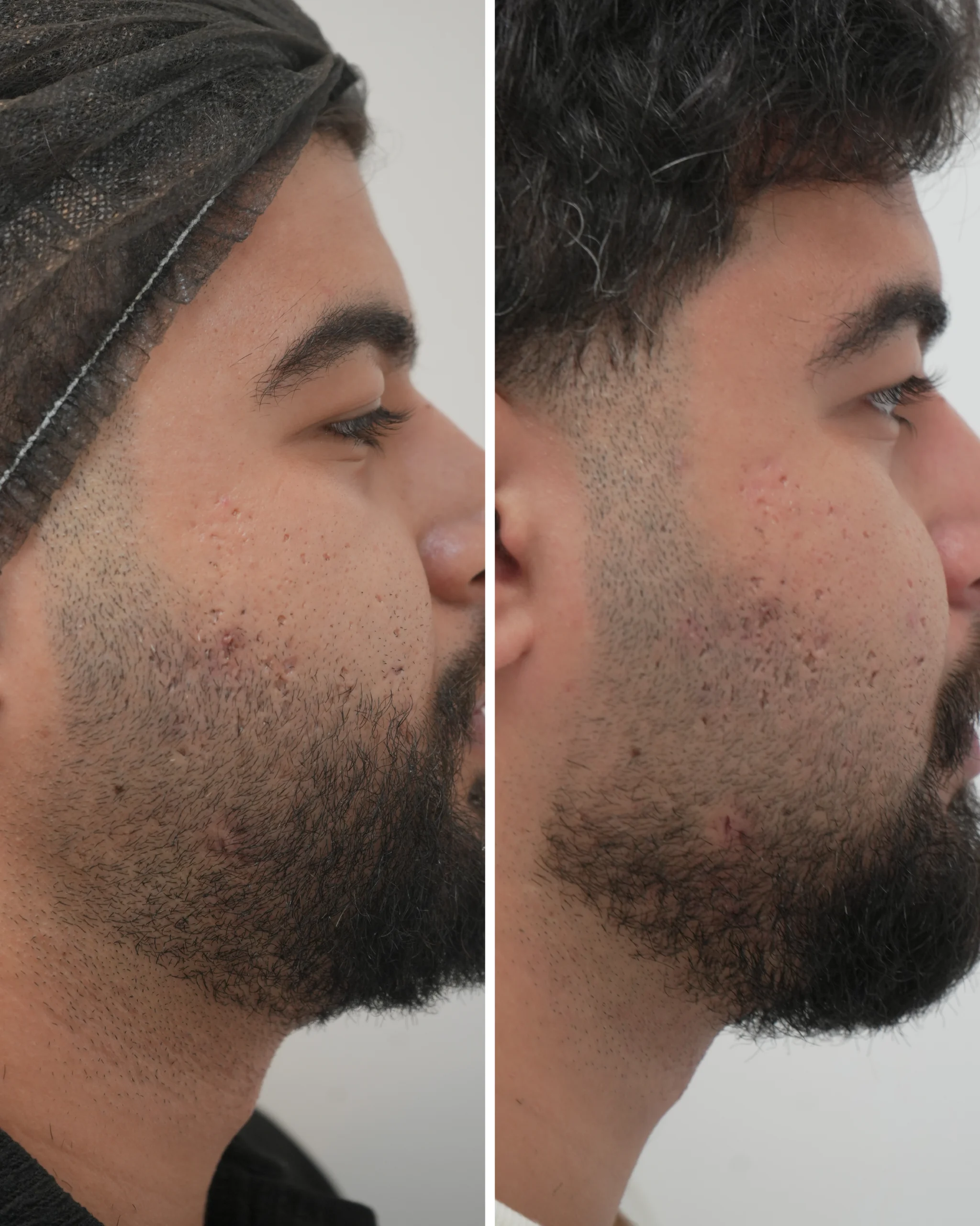 Acne Scar Removal