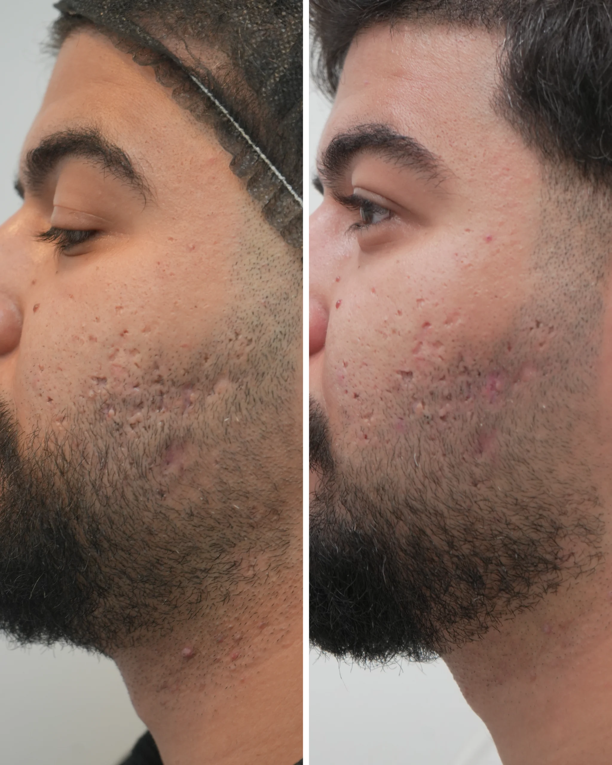 Acne Scar Removal