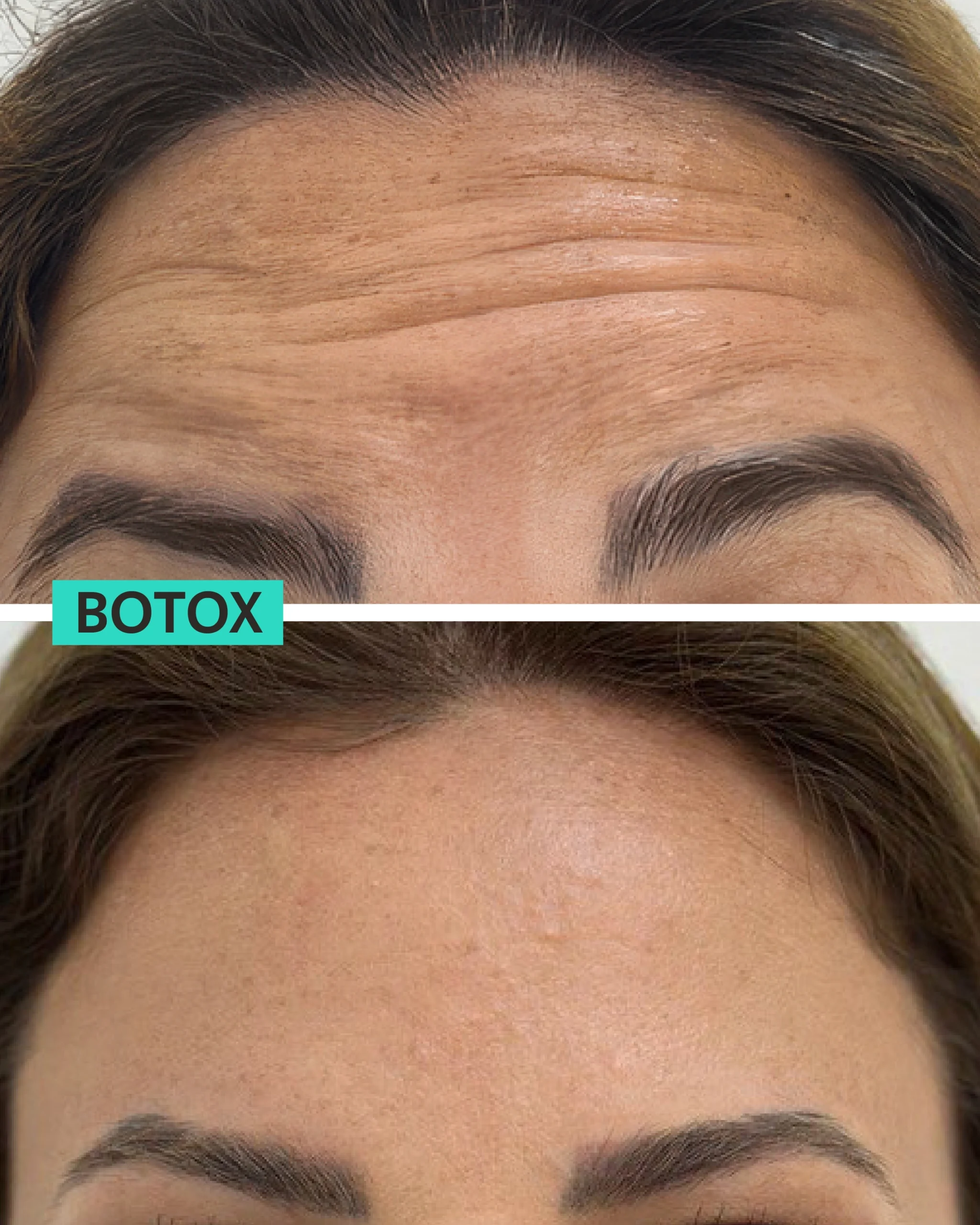 Botox Dubai