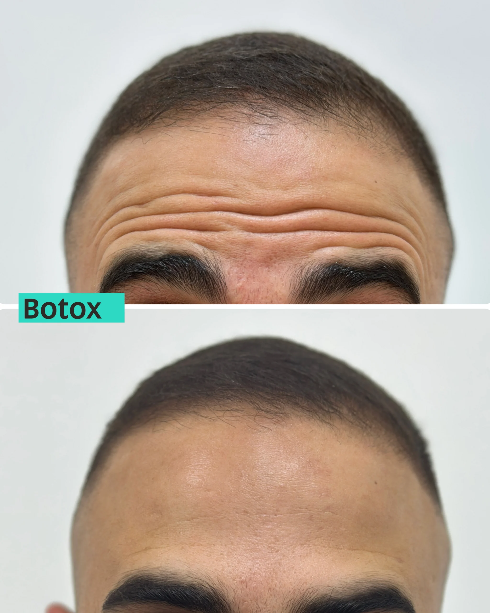 Botox Dubai