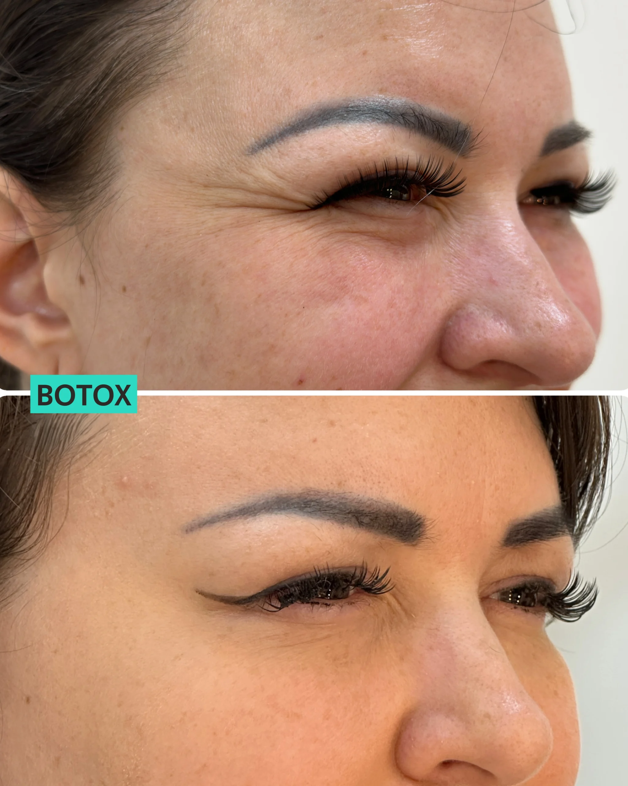 Botox Dubai