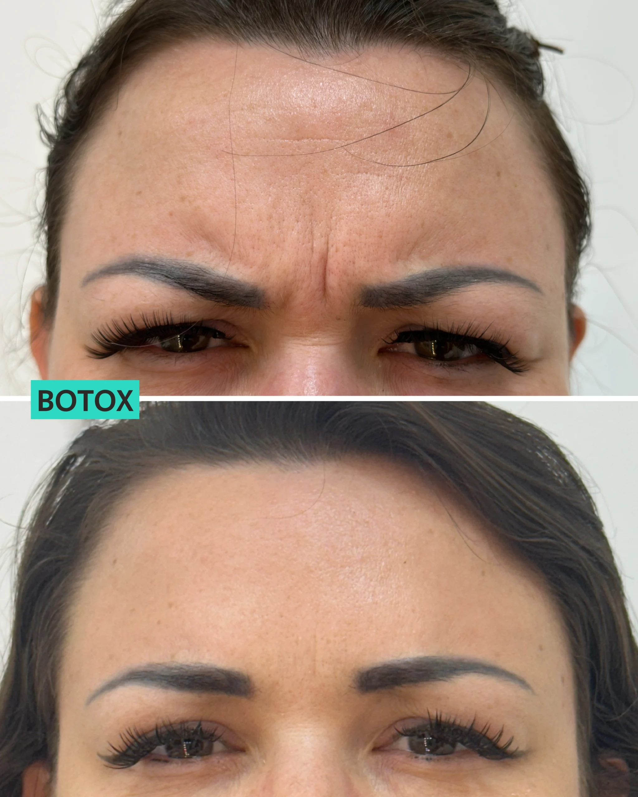 Botox Dubai
