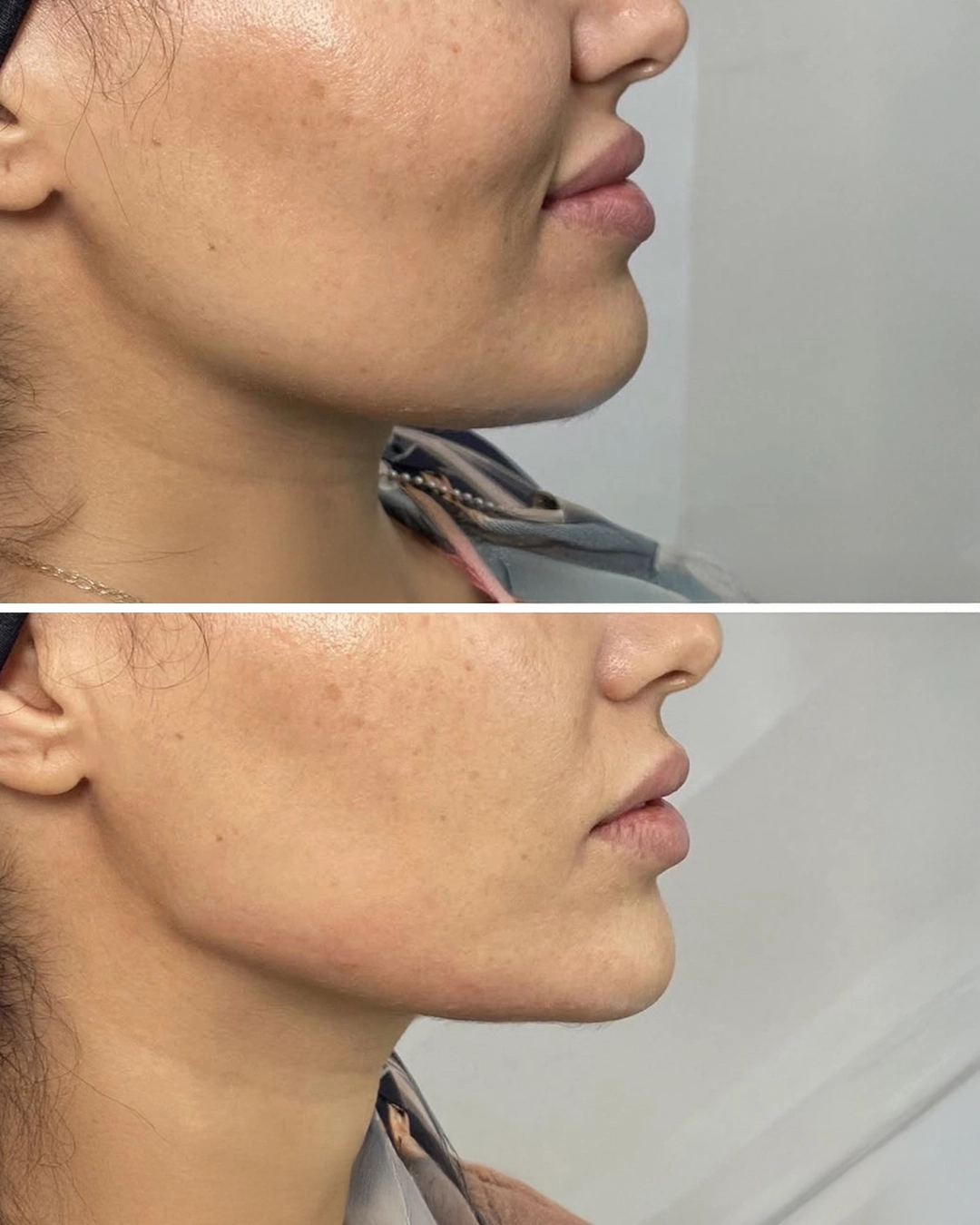 Jawline filler