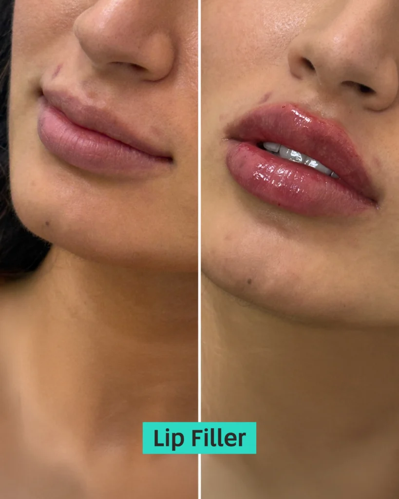 lip fillers dubai
