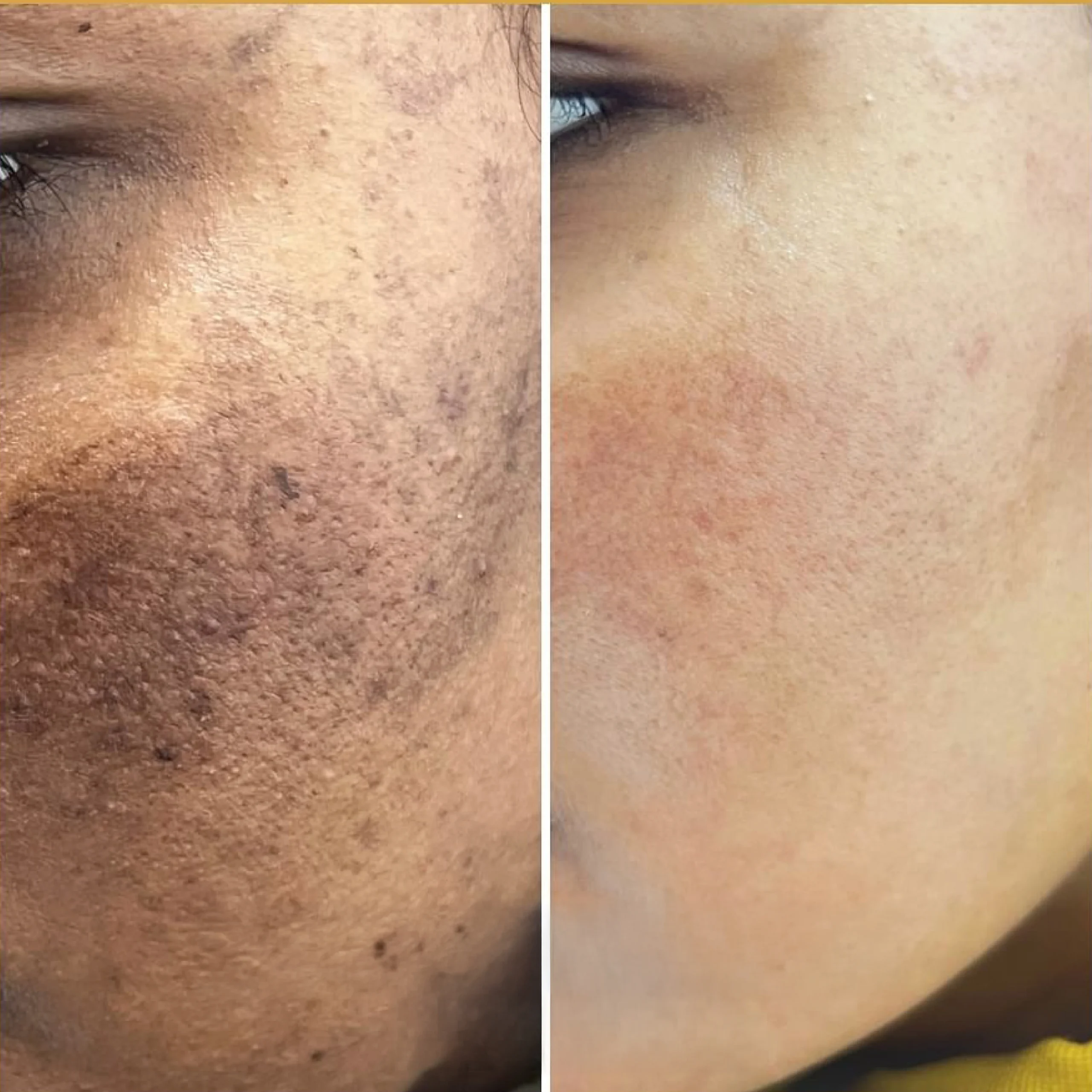 Melasma Treatment in Dubai