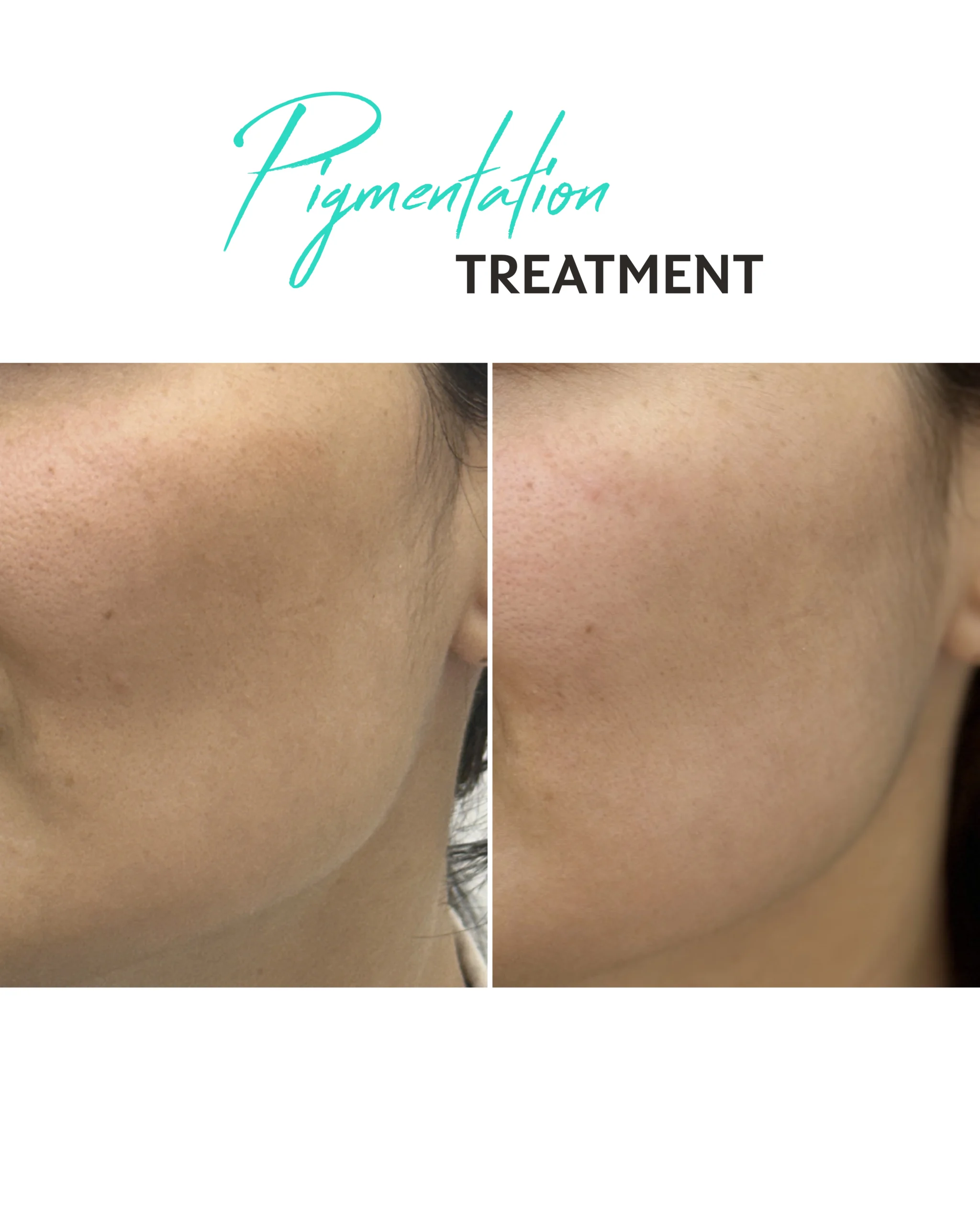 Pigmentation Treatments in Dubai
