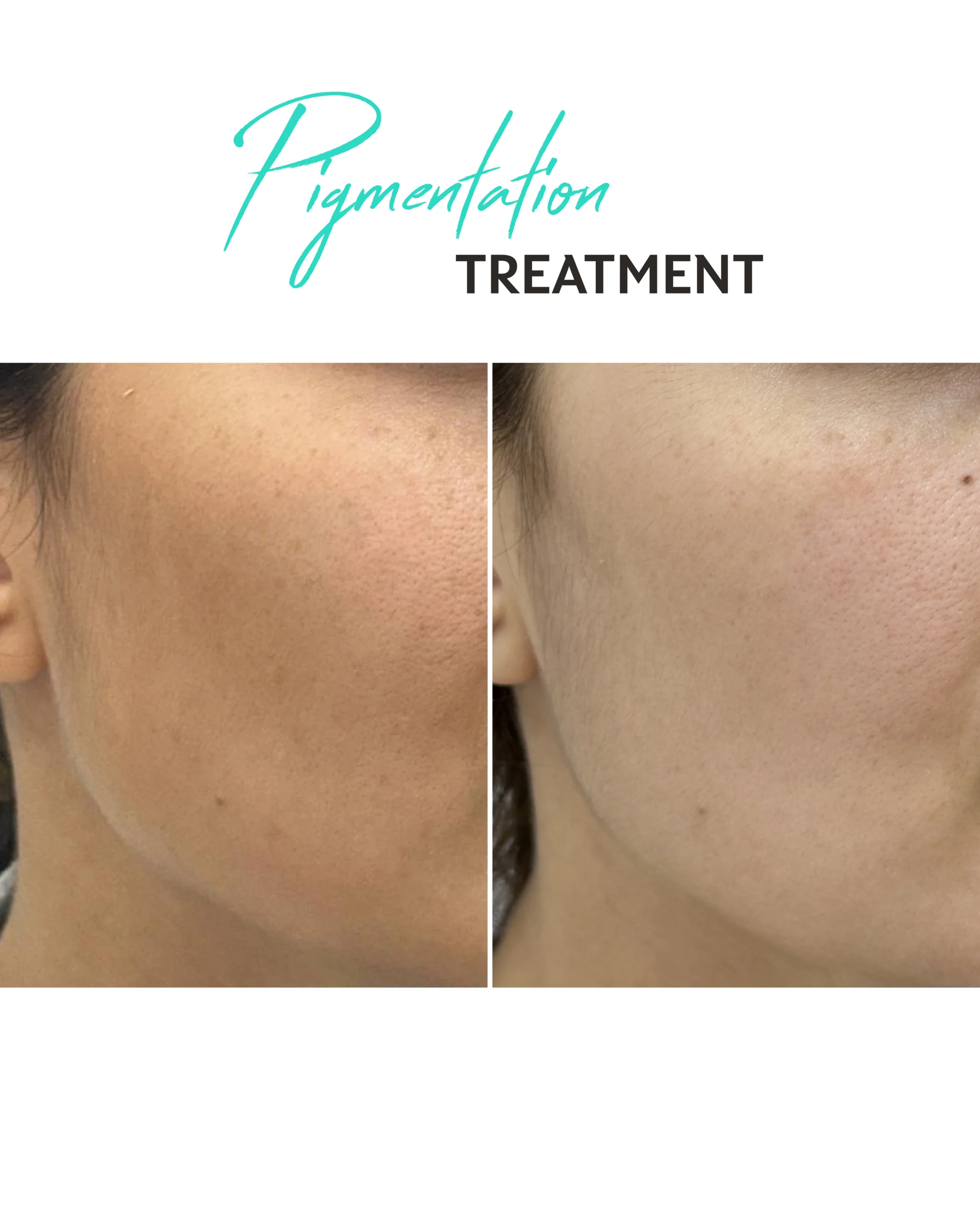 Pigmentation Treatments in Dubai