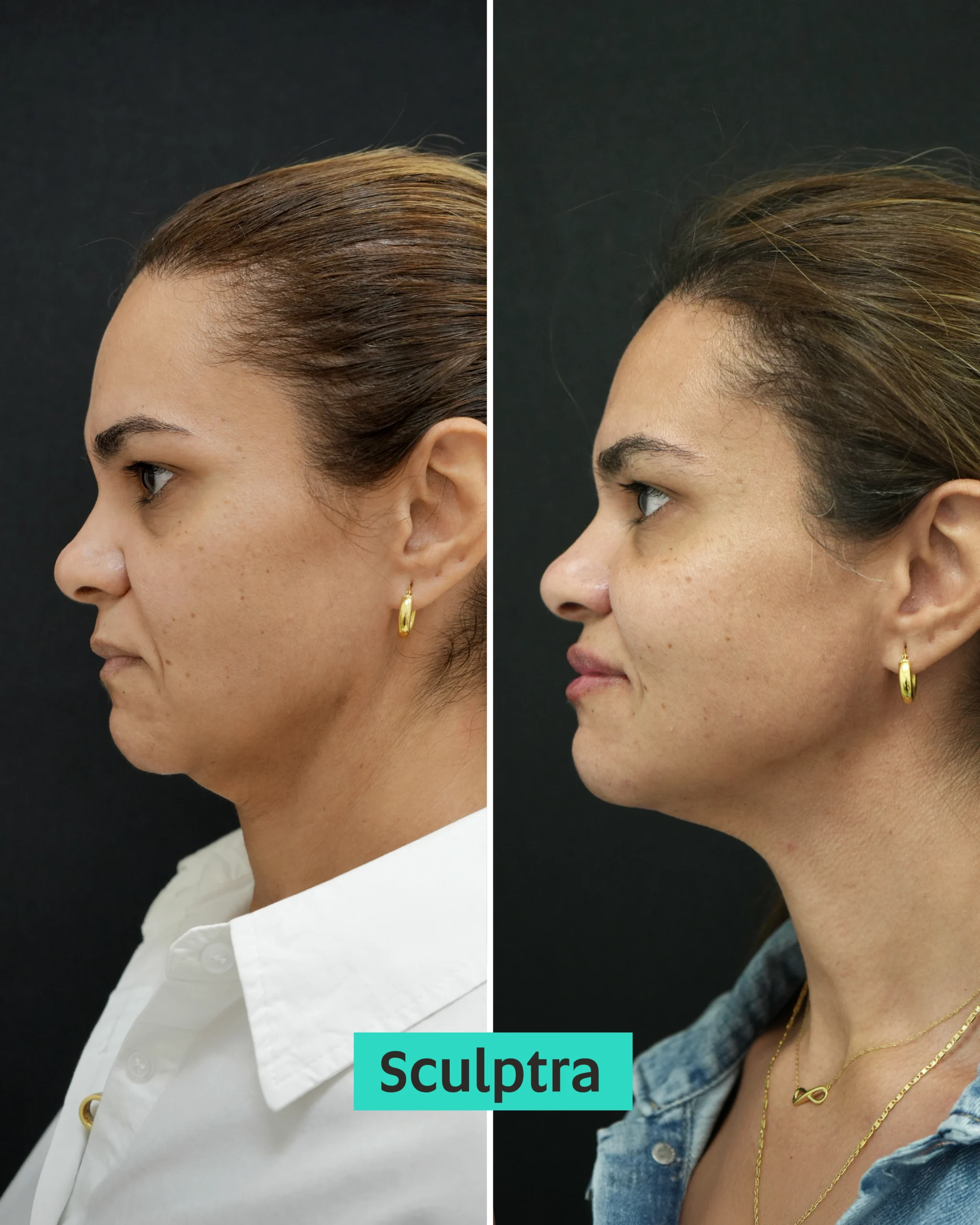 Sculptra Dubai