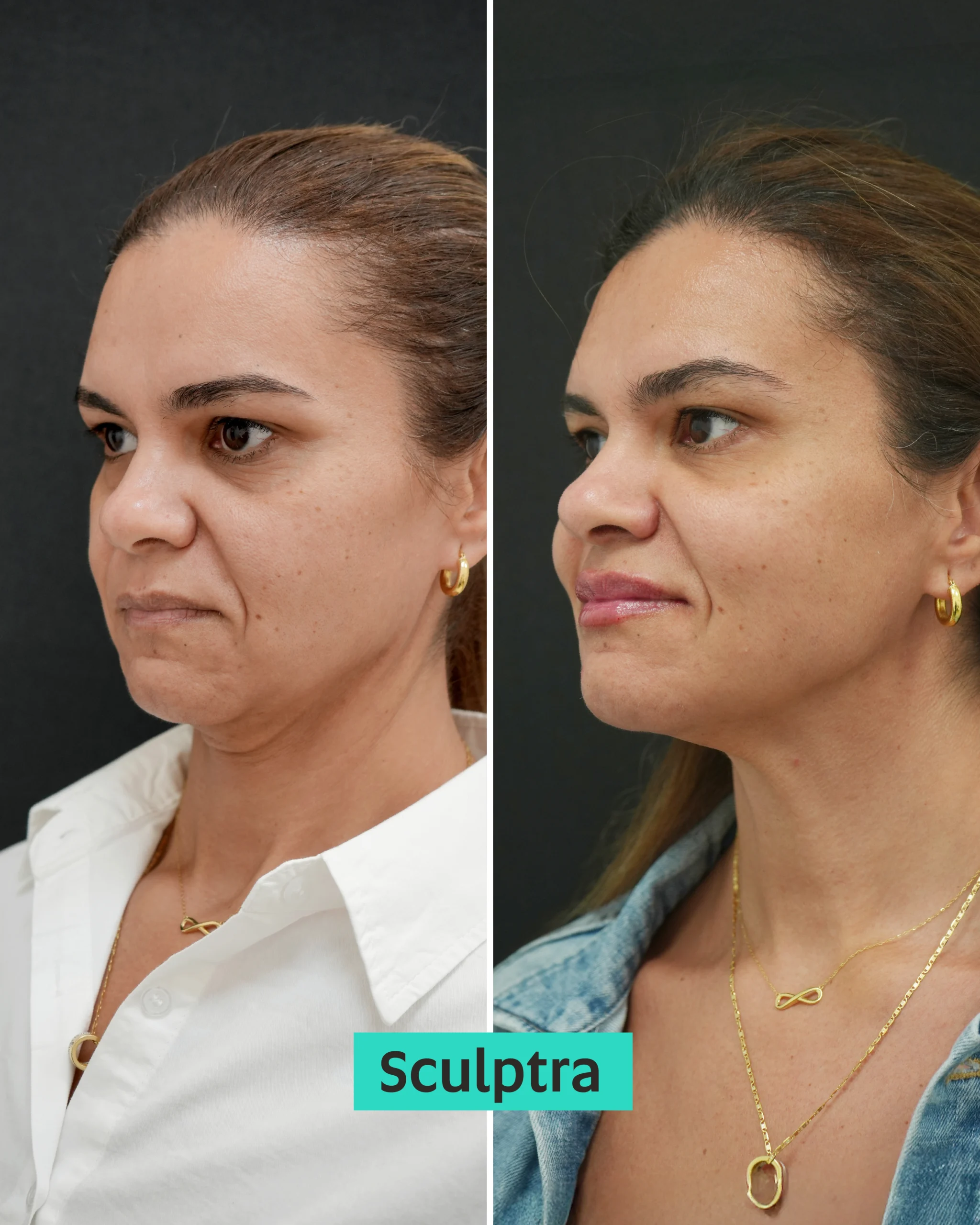 Sculptra Dubai