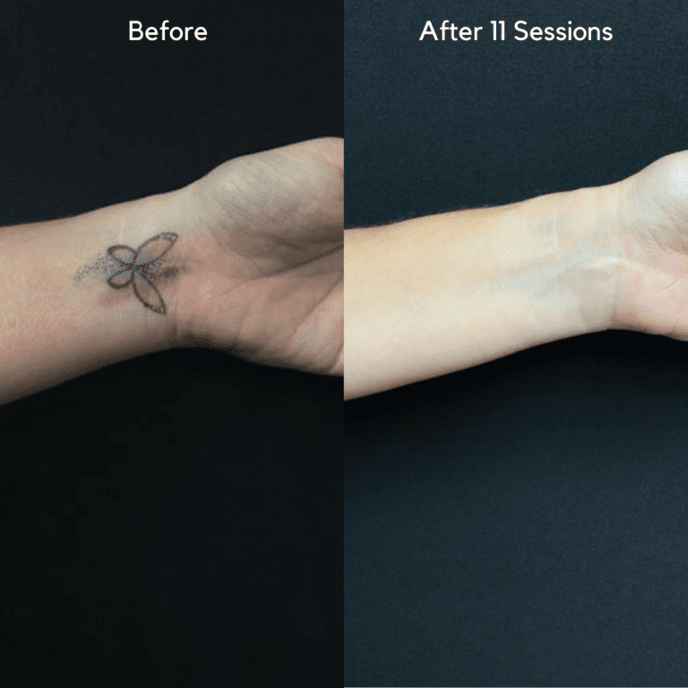 Tattoo Removal Dubai