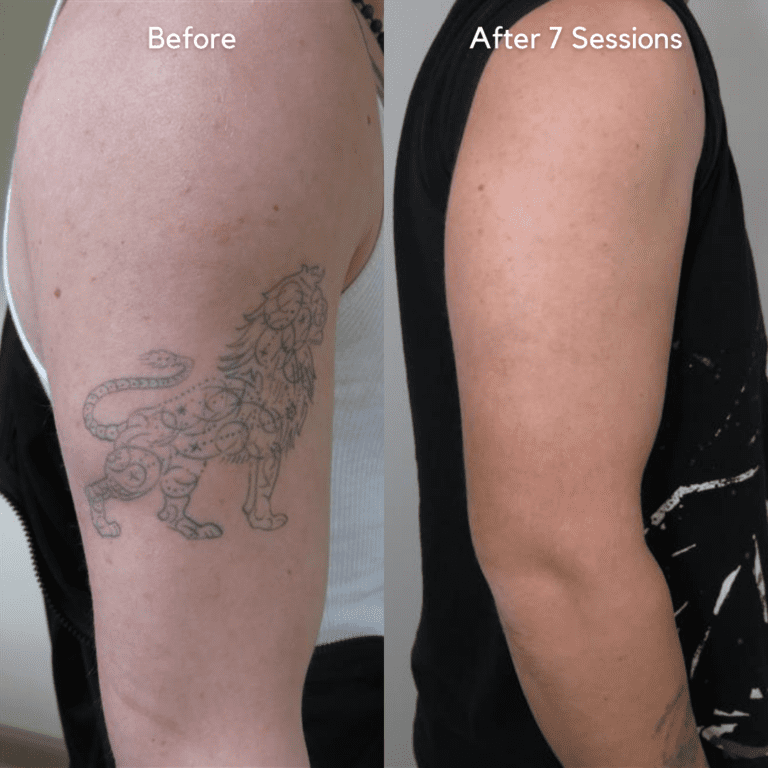 Tattoo Removal Dubai