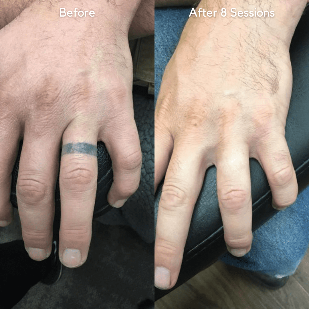 Tattoo Removal Dubai