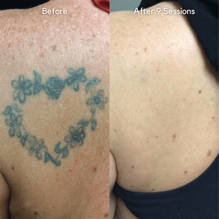 Tattoo Removal Dubai