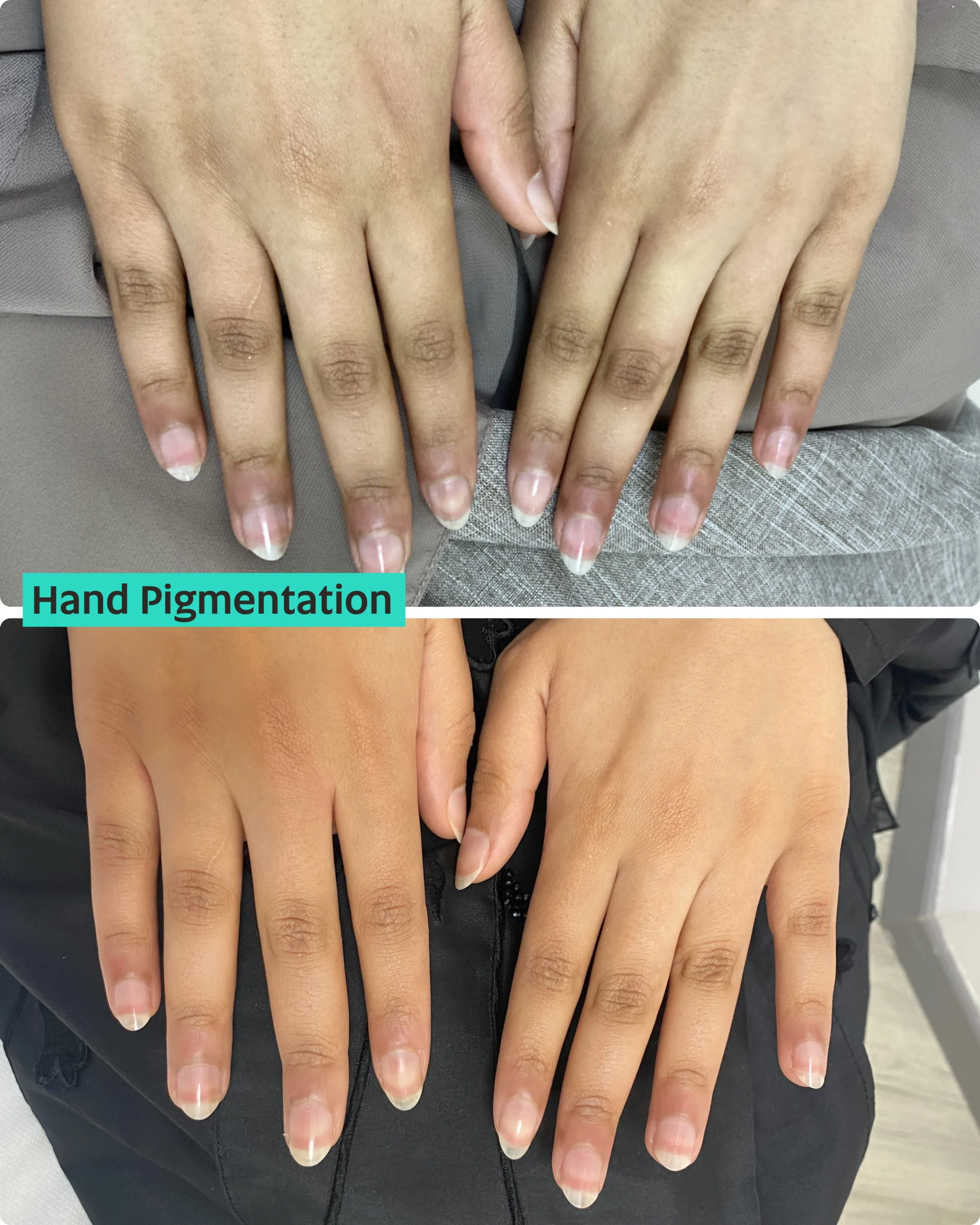 Pigmentation Treatments in Dubai