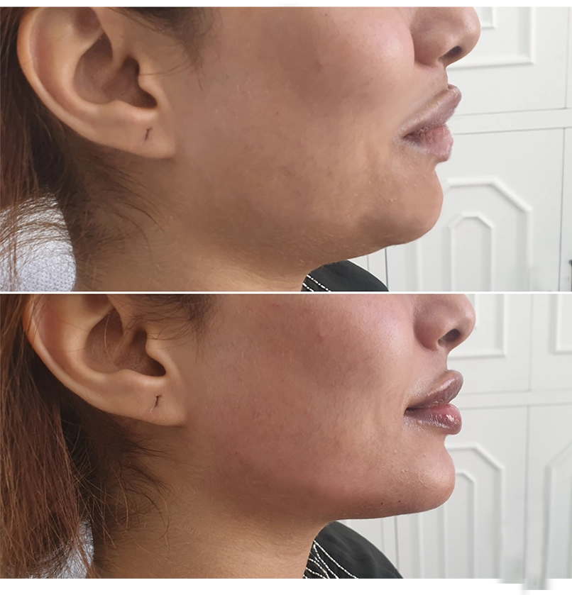 Jawline filler