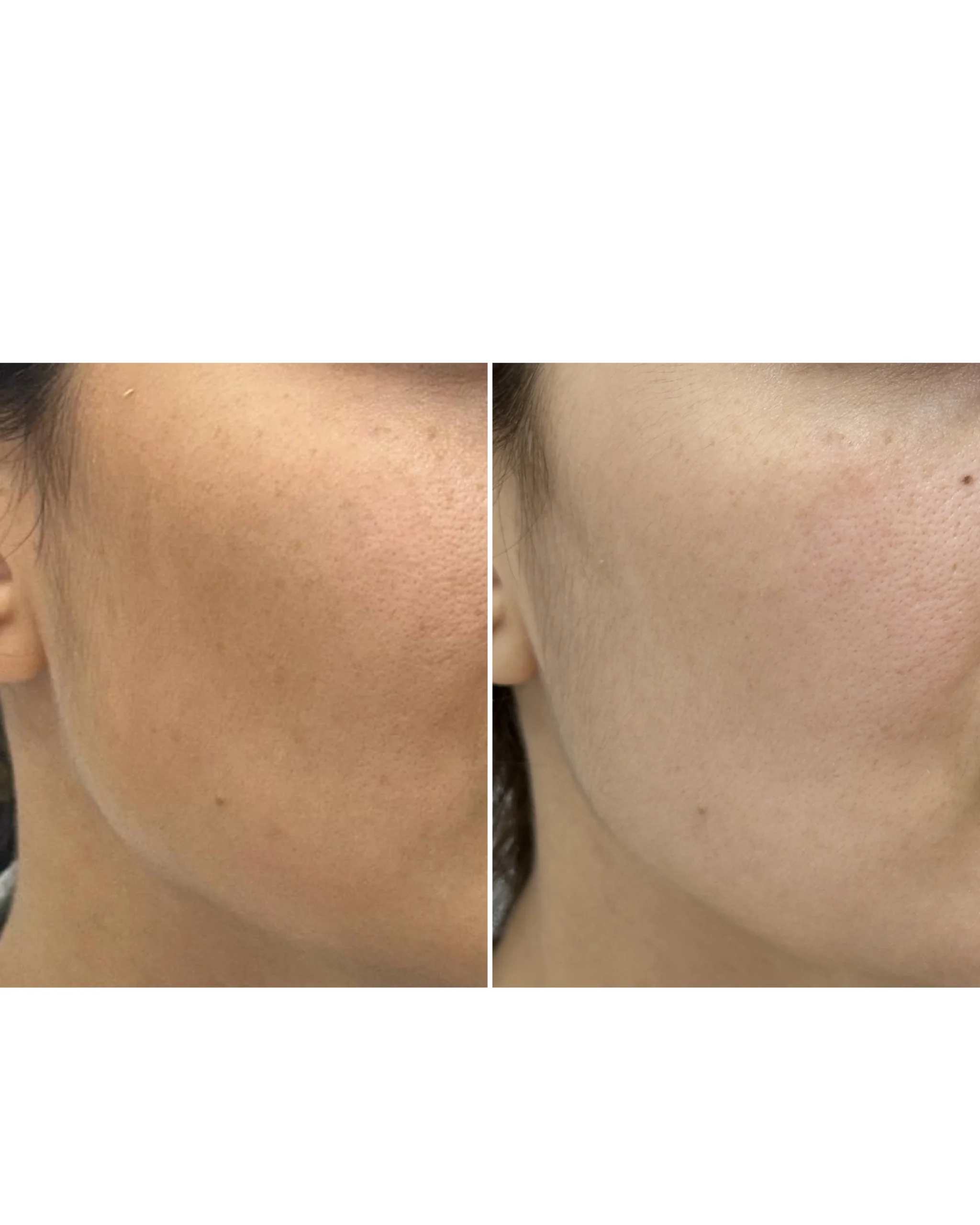 Melasma Treatment in Dubai