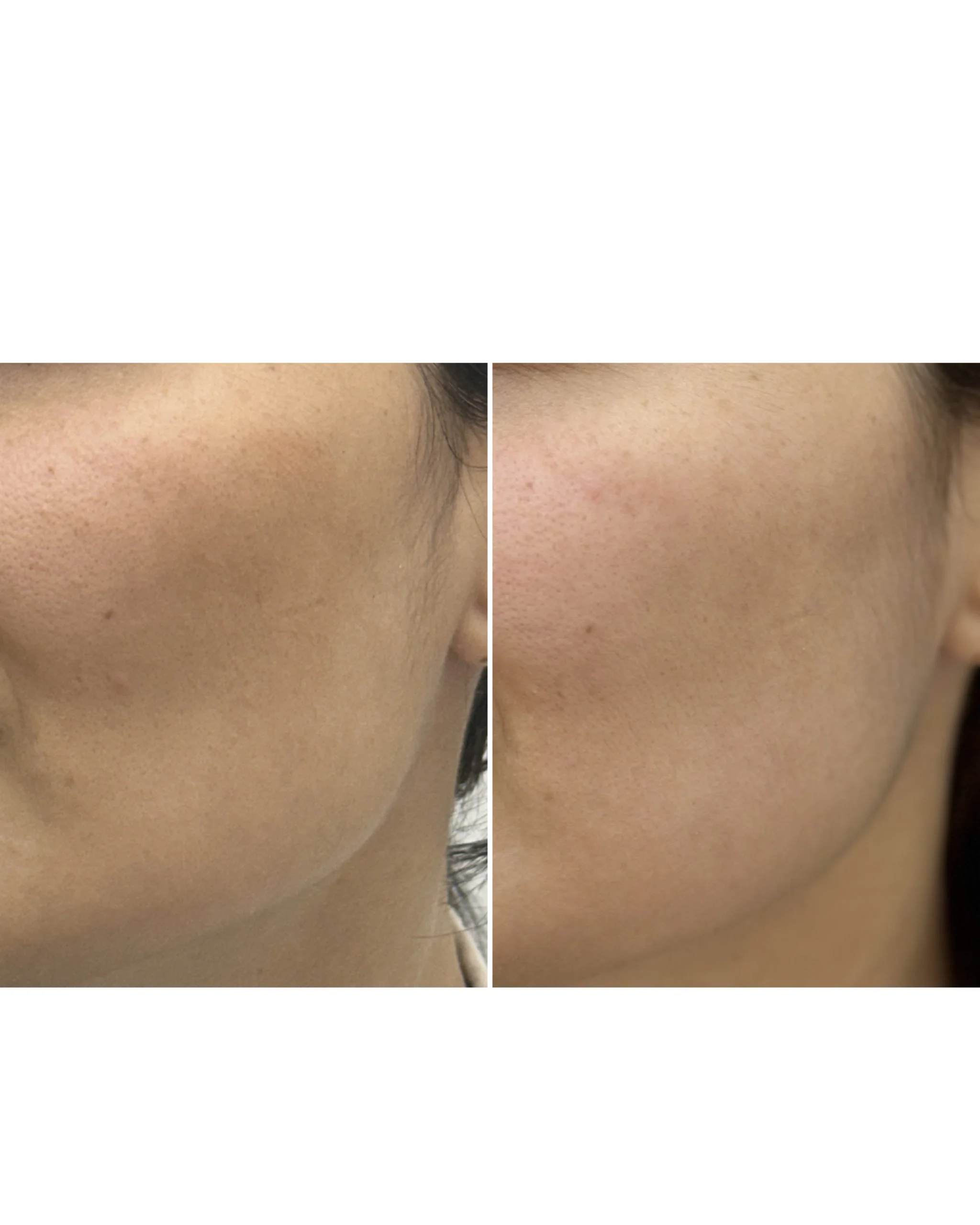 Melasma Treatment in Dubai