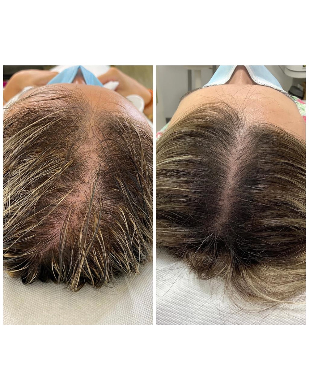 Best PRP Hair Treatment in Dubai