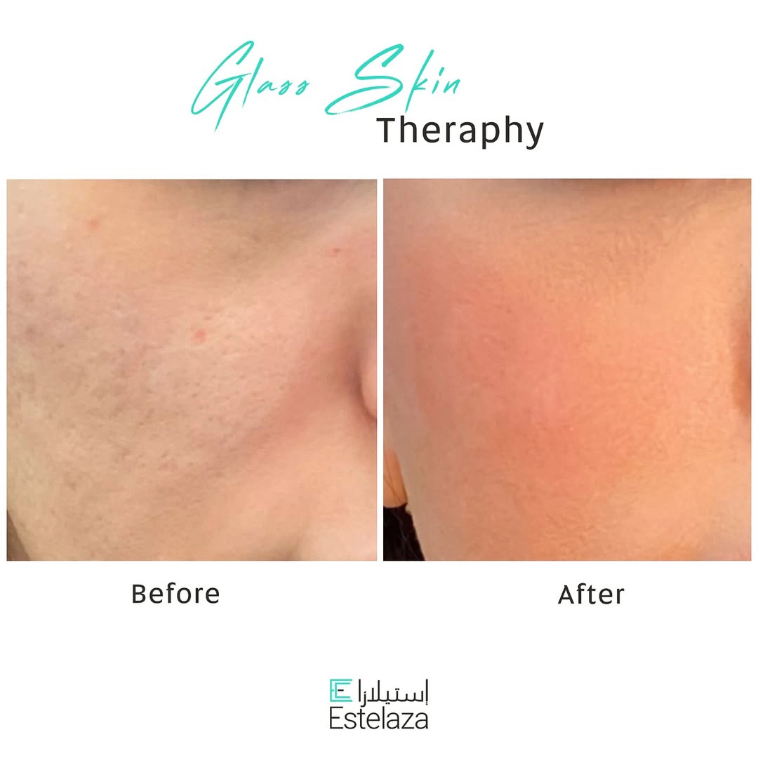 Glass Skin Treatment Dubai 