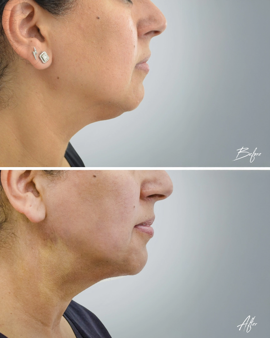 Endolift dubai