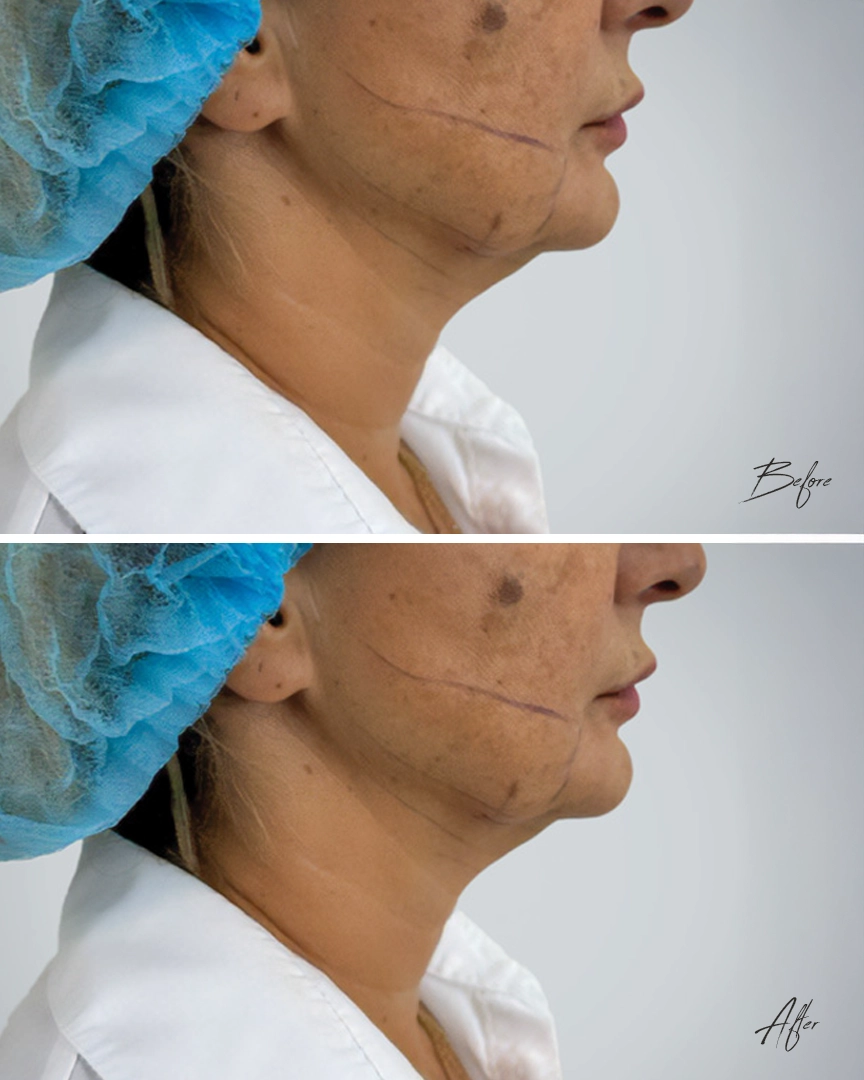 Endolift dubai