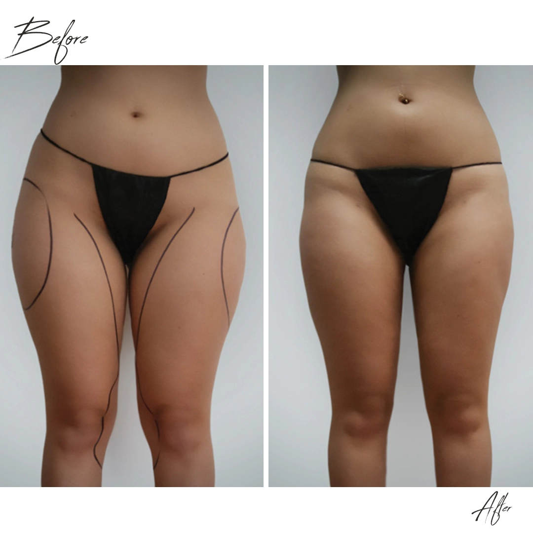 Endolift dubai