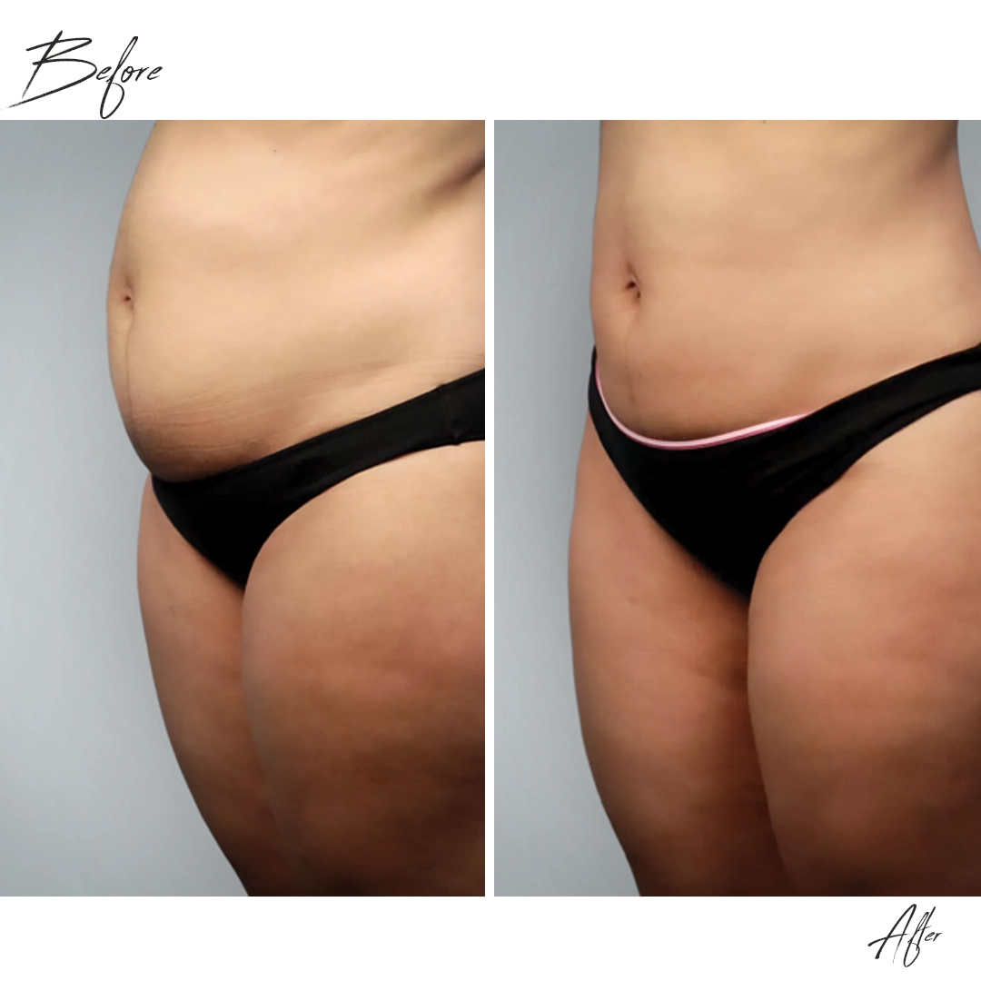 laser liposuction in dubai