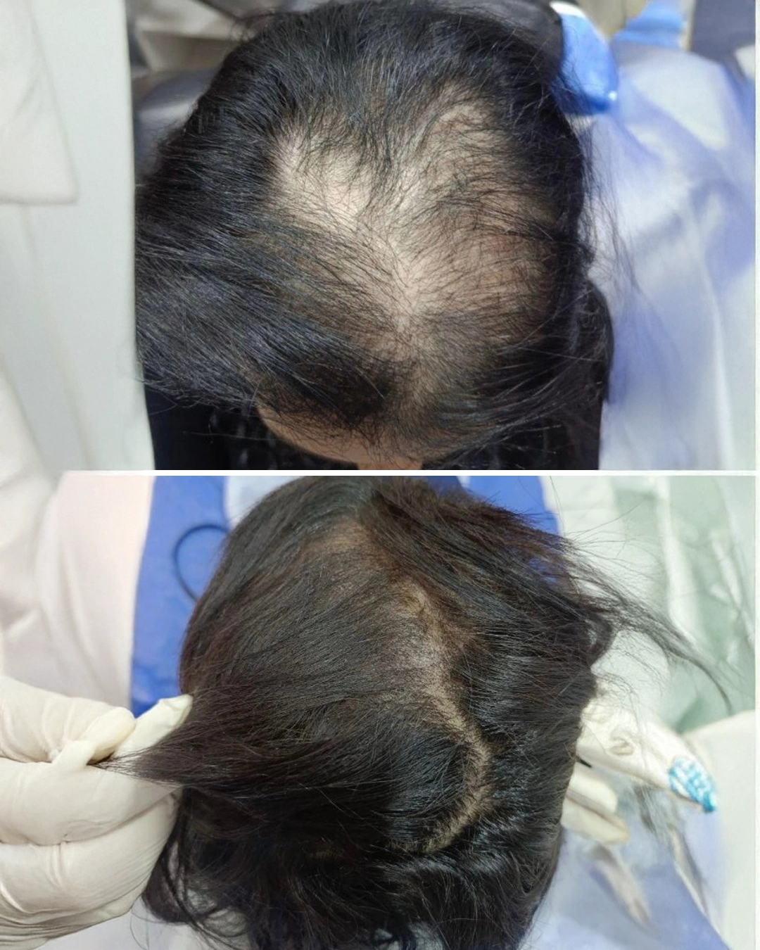 hair loss treatment