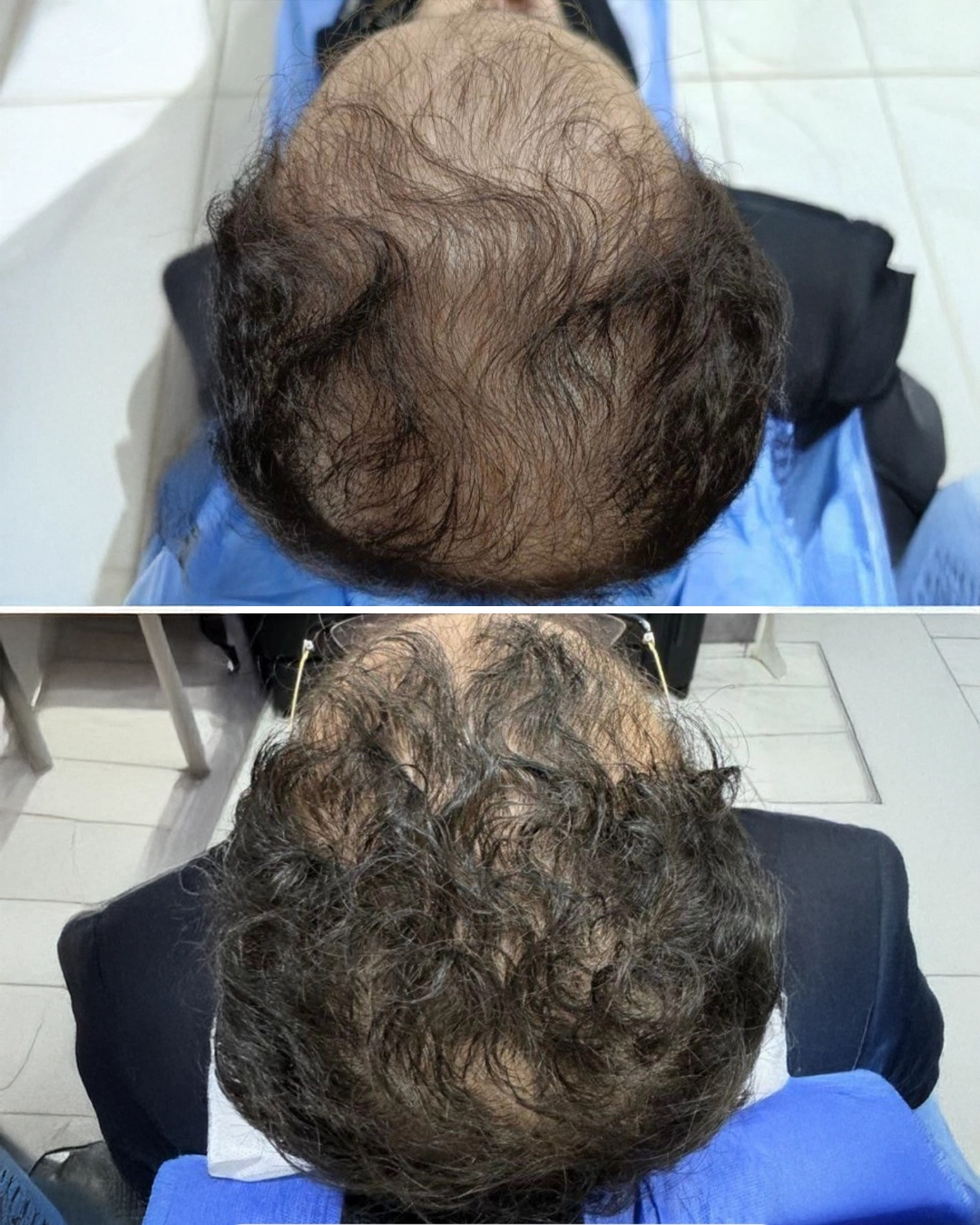 hair loss treatment