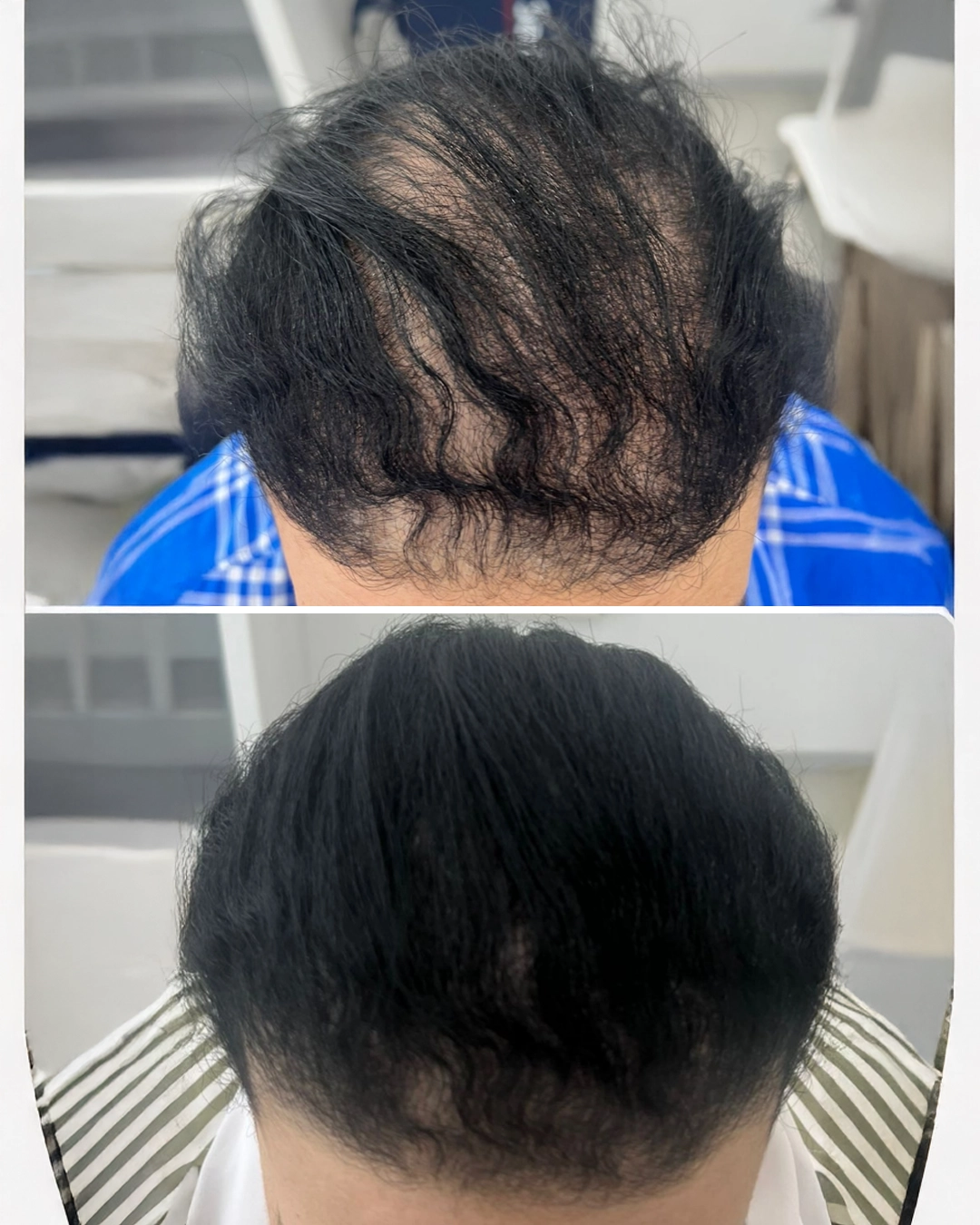 hair loss treatment
