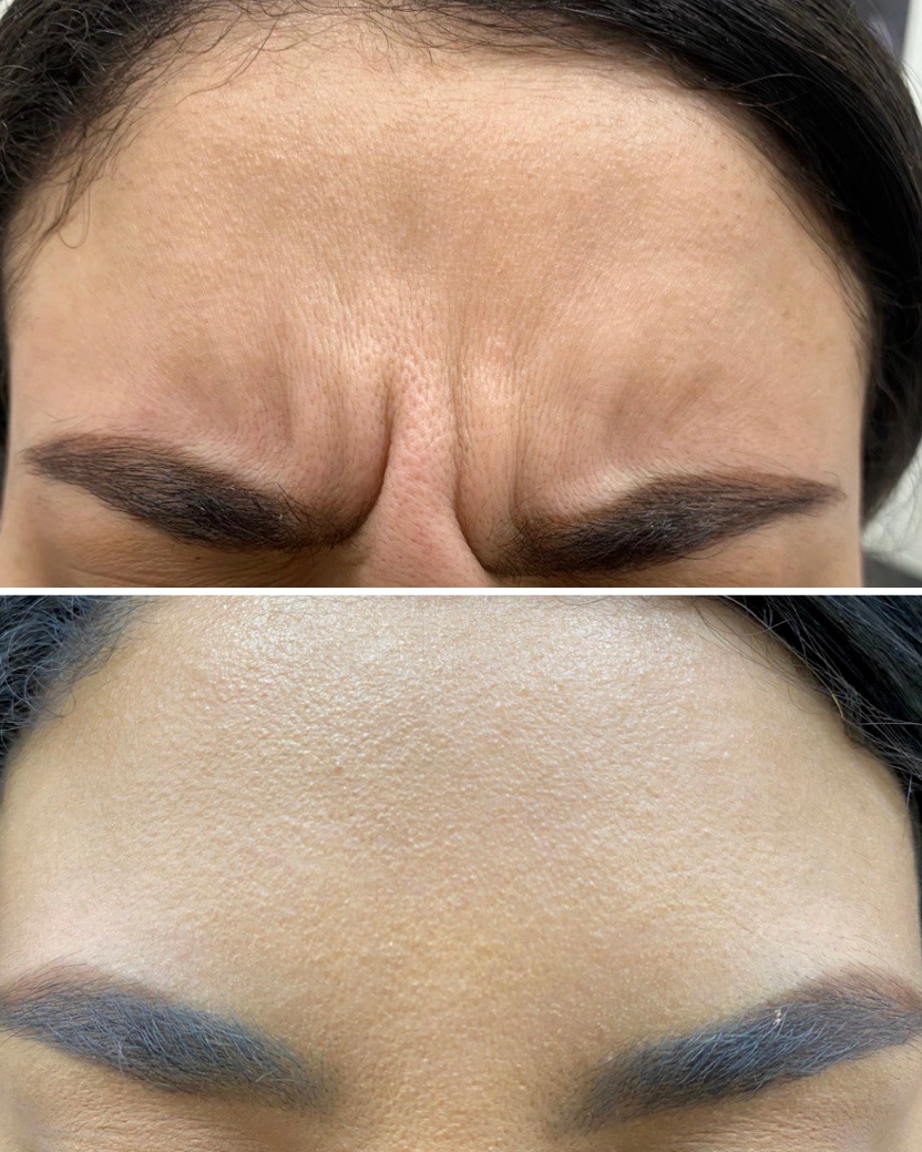 Forehead & Frown Lines Botox in Dubai