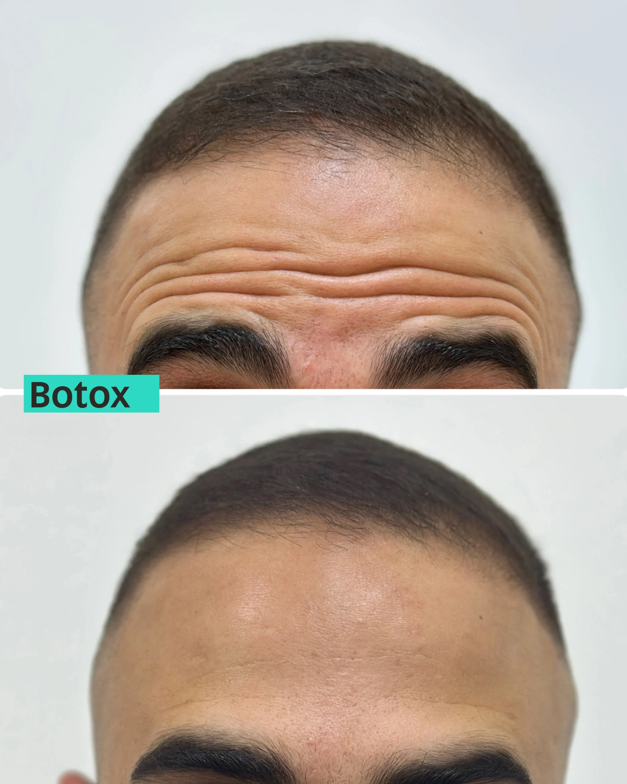 Forehead & Frown Lines Botox in Dubai 