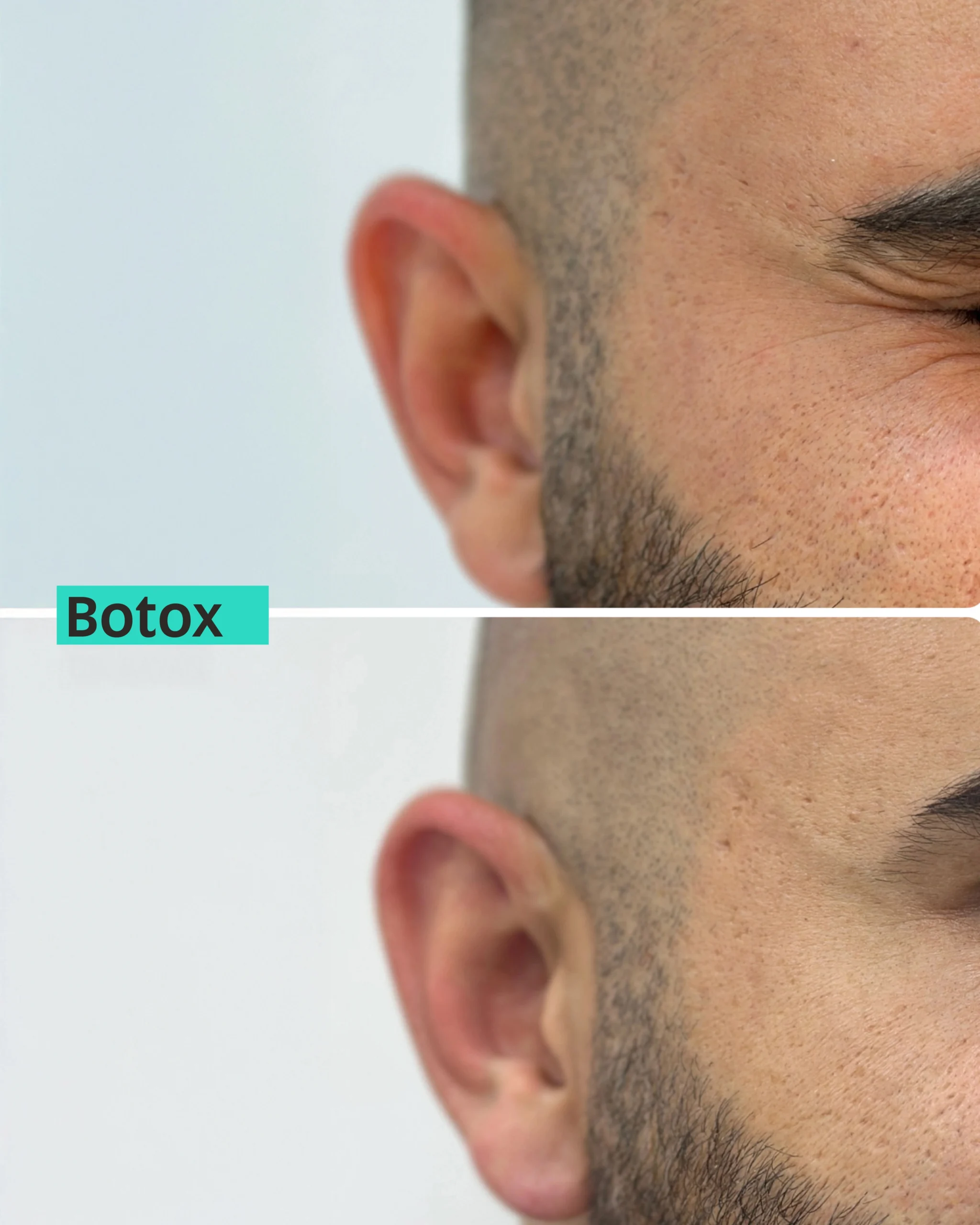 Forehead & Frown Lines Botox in Dubai