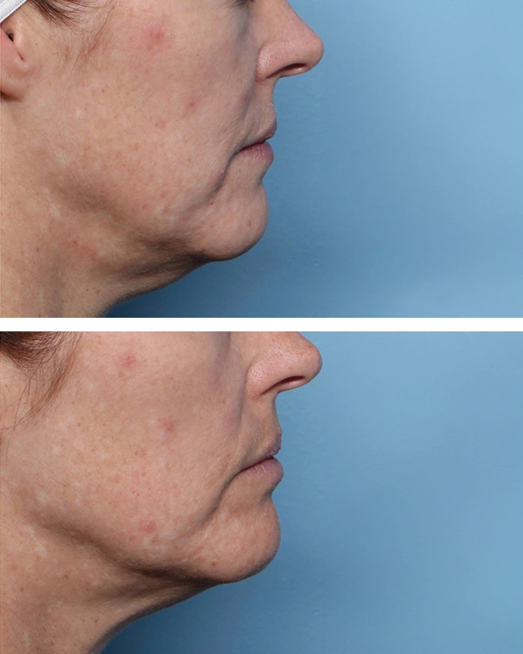 XERF Treatment in Dubai