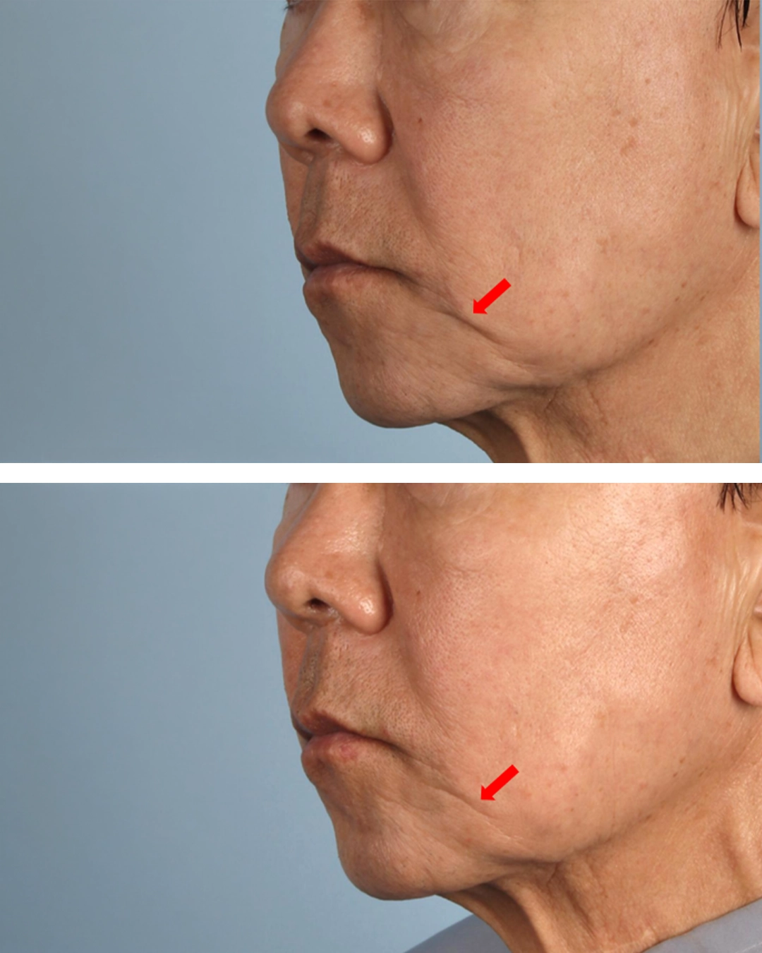 XERF Treatment in Dubai