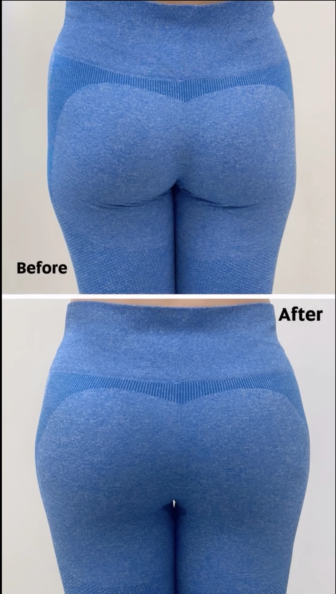 body filler treatment in dubai