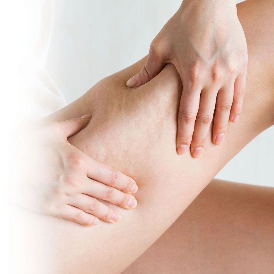 Cellulite Treatment