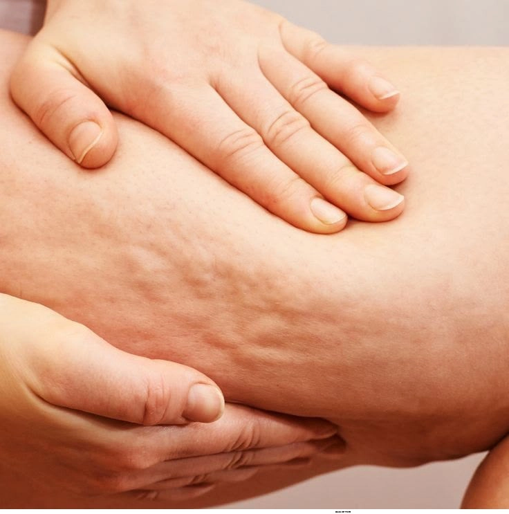 Cellulite Treatment