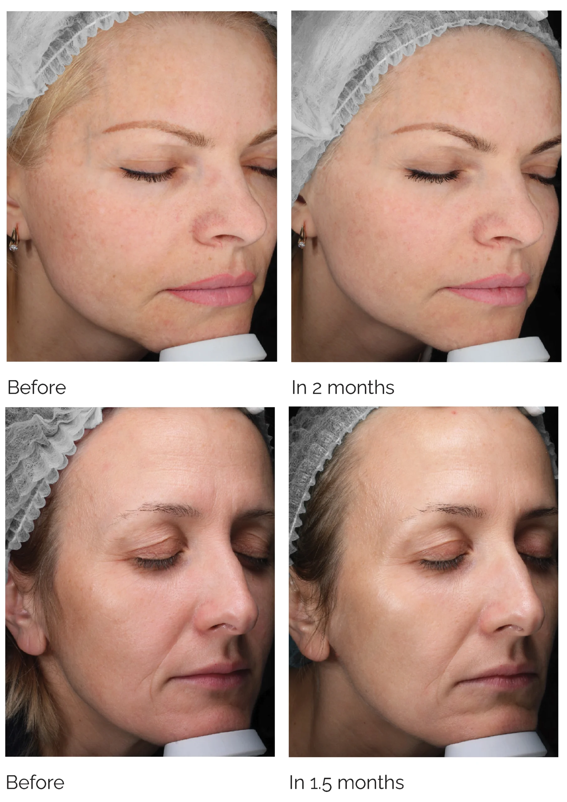 ELECTRI Skin Booster