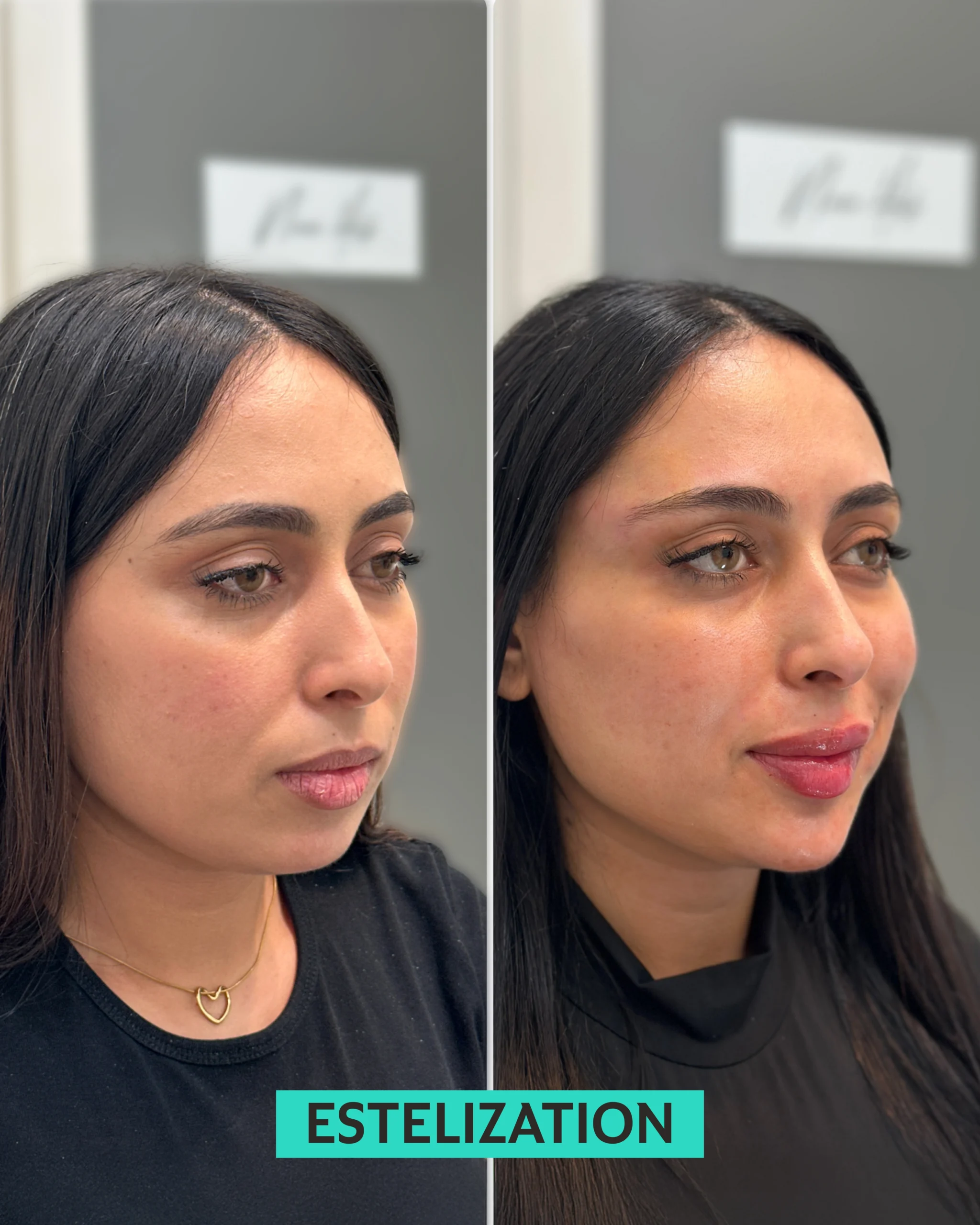 skinboosters