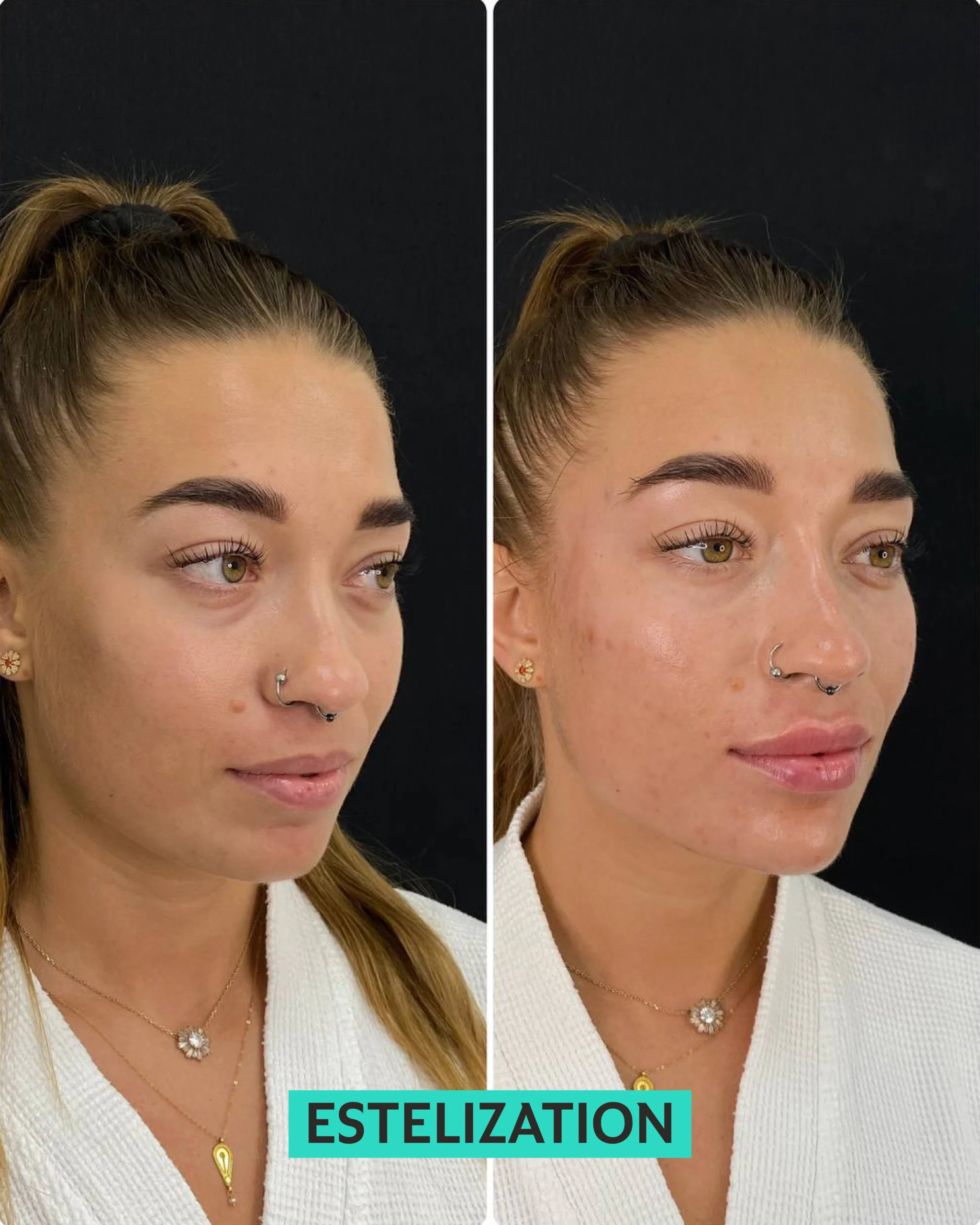 skin boosters