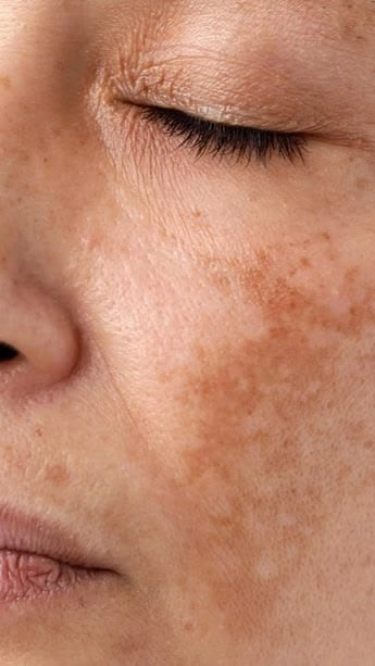 Hyperpigmentation Treatment