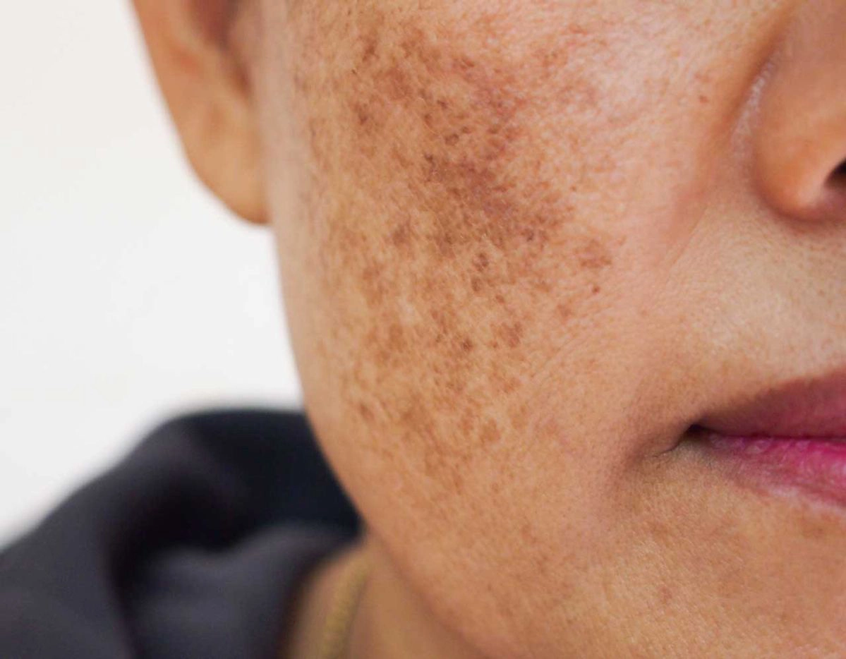 Hyperpigmentation Treatment