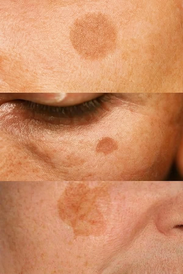 Hyperpigmentation Treatment
