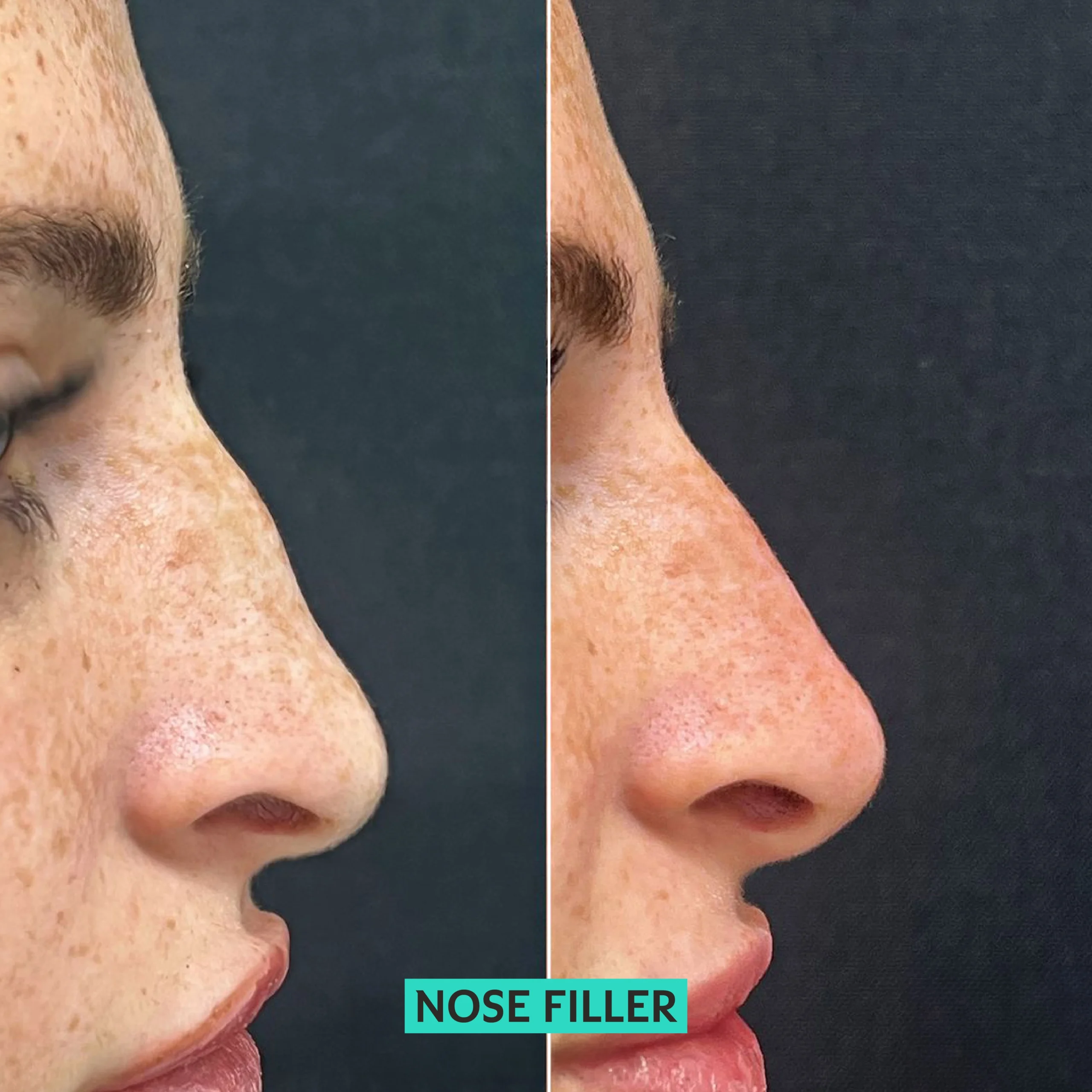 nose filler
