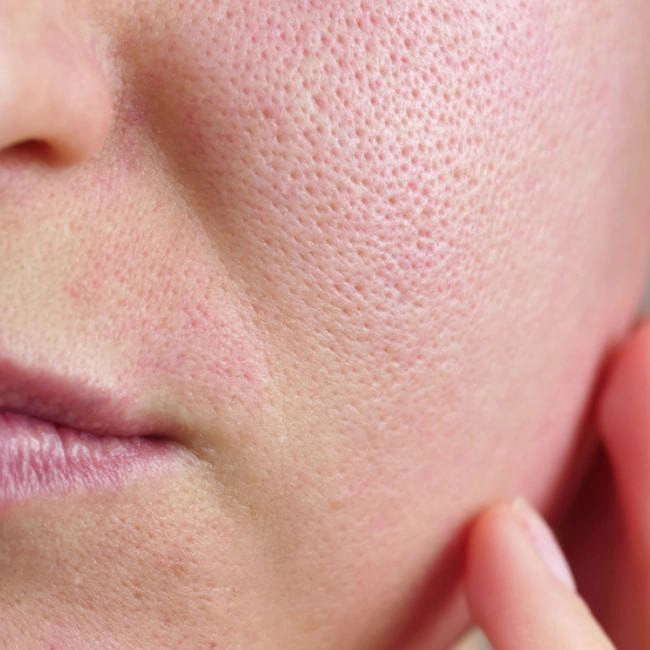 Open Pores Treatment 