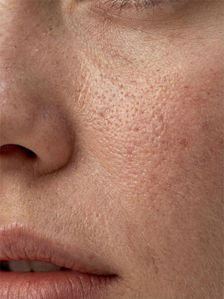 Open Pores Treatment