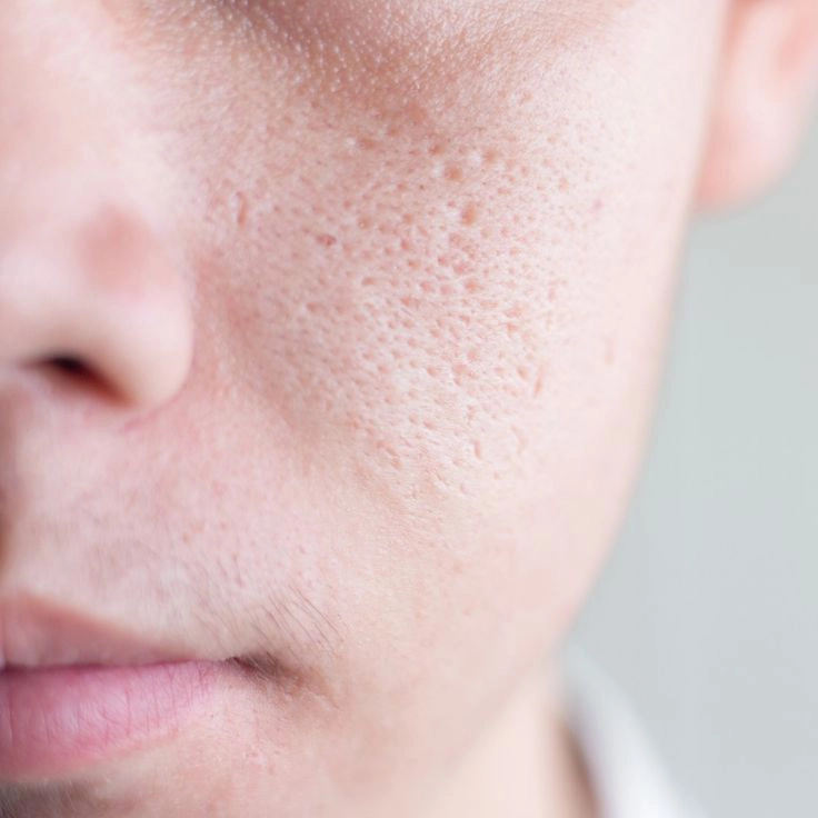 Open Pores